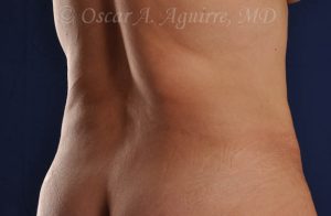 CoolSculpting treatments to Upper and Lower Abdomen, Flanks, Bra Fat, and Arms
