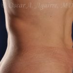 CoolSculpting treatments to Upper and Lower Abdomen, Flanks, Bra Fat, and Arms
