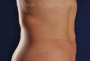 CoolSculpting treatments to Upper and Lower Abdomen, Flanks, Bra Fat, and Arms