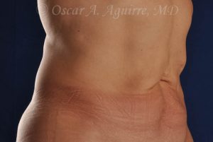 CoolSculpting treatments to Upper and Lower Abdomen, Flanks, Bra Fat, and Arms