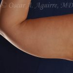 CoolSculpting treatments to Upper and Lower Abdomen, Flanks, Bra Fat, and Arms