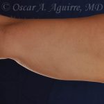 CoolSculpting treatments to Upper and Lower Abdomen, Flanks, Bra Fat, and Arms