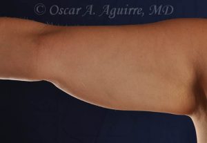 CoolSculpting treatments to Upper and Lower Abdomen, Flanks, Bra Fat, and Arms