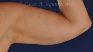 CoolSculpting treatments to Upper and Lower Abdomen, Flanks, Bra Fat, and Arms