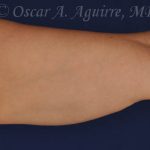 CoolSculpting treatments to Upper and Lower Abdomen, Flanks, Bra Fat, and Arms