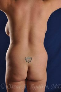 Preop Vaginoplasty with Suburethral Sling, Vaser Liposuction of the Upper/Lower Abdomen, Anterior Hips, Mons, Bra Fat and Upper/Lower Back