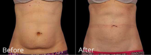 Without a doubt, 2017 is the year for a trimmer and slimmer you with CoolSculpting at Aguirre Speciality Care!