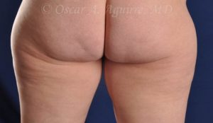 Post CoolSculpting of the Inner and Outer Thighs