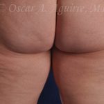 Pre CoolSculpting of the Inner and Outer Thighs