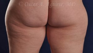 Pre CoolSculpting of the Inner and Outer Thighs
