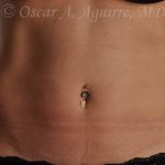 Pre CoolSculpting-Anterior and Posterior Flanks