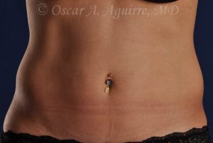 Pre CoolSculpting-Anterior and Posterior Flanks