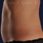 Pre CoolSculpting-Anterior and Posterior Flanks