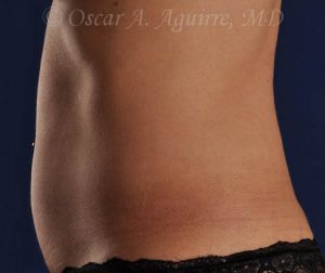 Pre CoolSculpting-Anterior and Posterior Flanks