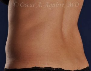 Pre CoolSculpting-Anterior and Posterior Flanks