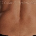 Pre CoolSculpting-Anterior and Posterior Flanks