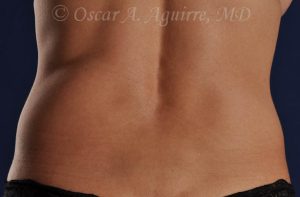 Pre CoolSculpting-Anterior and Posterior Flanks