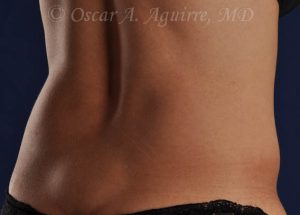 Pre CoolSculpting-Anterior and Posterior Flanks