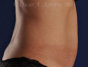 Pre CoolSculpting-Anterior and Posterior Flanks