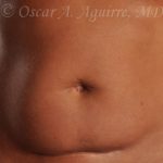 CoolSculpting of the Upper and Lower Abdomen and bilateral Flanks