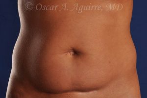 CoolSculpting of the Upper and Lower Abdomen and bilateral Flanks