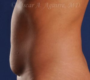 CoolSculpting of the Upper and Lower Abdomen and bilateral Flanks