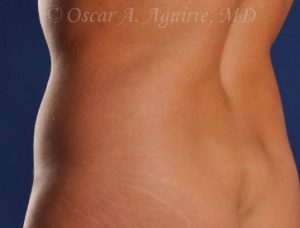 CoolSculpting of the Upper and Lower Abdomen and bilateral Flanks