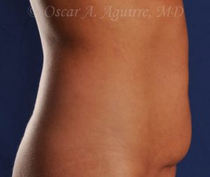 CoolSculpting of the Upper and Lower Abdomen