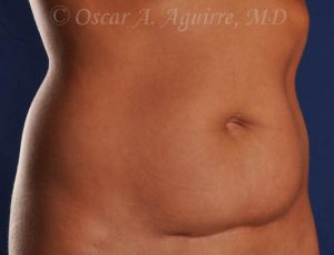 CoolSculpting of the Upper and Lower Abdomen and bilateral Flanks