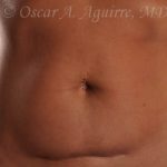 CoolSculpting of the Upper and Lower Abdomen and bilateral Flanks