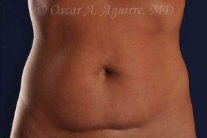 CoolSculpting of the Upper and Lower Abdomen and bilateral Flanks