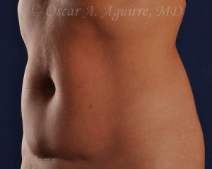 CoolSculpting of the Upper and Lower Abdomen and bilateral Flanks