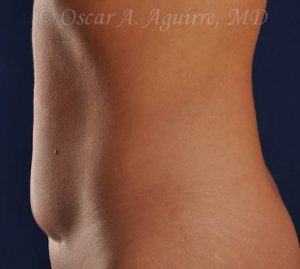 CoolSculpting of the Upper and Lower Abdomen and bilateral Flanks