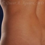 CoolSculpting of the Upper and Lower Abdomen and bilateral Flanks