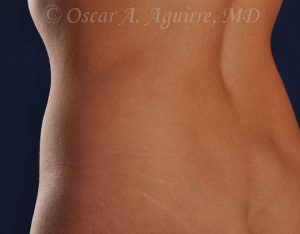 CoolSculpting of the Upper and Lower Abdomen and bilateral Flanks