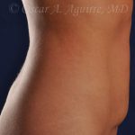 CoolSculpting of the Upper and Lower Abdomen and bilateral Flanks