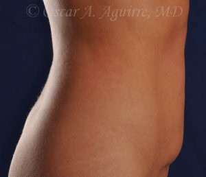 CoolSculpting of the Upper and Lower Abdomen and bilateral Flanks