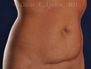 CoolSculpting of the Upper and Lower Abdomen and bilateral Flanks