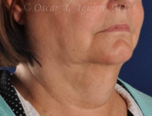 Pre CoolSculpting- Submental Treatment
