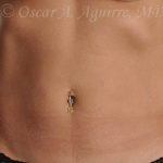 Post CoolSculpting-Anterior and Posterior Flanks