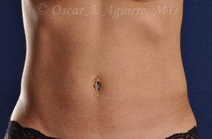 Post CoolSculpting-Anterior and Posterior Flanks