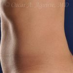 Post CoolSculpting-Anterior and Posterior Flanks