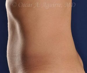 Post CoolSculpting-Anterior and Posterior Flanks