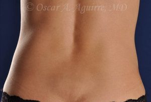 Post CoolSculpting-Anterior and Posterior Flanks