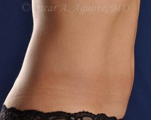 Post CoolSculpting-Anterior and Posterior Flanks