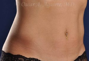 Post CoolSculpting-Anterior and Posterior Flanks