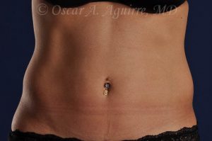 Pre CoolSculpting-Anterior and Posterior Flanks