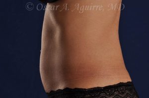 Pre CoolSculpting-Anterior and Posterior Flanks