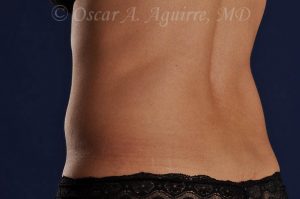 Pre CoolSculpting-Anterior and Posterior Flanks