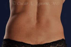 Pre CoolSculpting-Anterior and Posterior Flanks